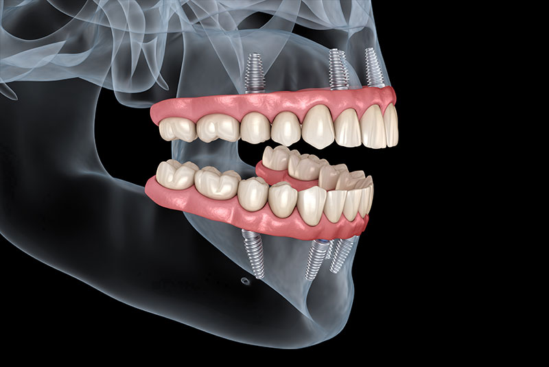 full arch dental implants